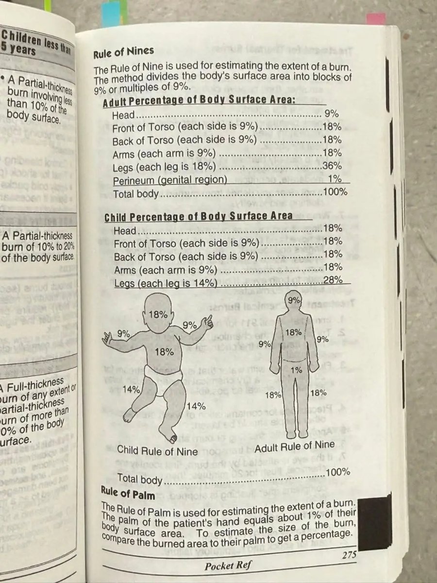 Children less than 5 years • A Partial-thickness burn involving less than 10% of the body surface. A Partial-thickness burn of 10% to 20% of the body surface. Full-thickness urn of any extent or artial-thickness urn of more than 0% of the body urface. 9% 18% 18% 18% 36% 1% Rule of Nines The Rule of Nine is used for estimating the extent of a burn. The method divides the body's surface area into blocks of 9% or multiples of 9%. Adult Percentage of Body Surface Area: Head Front of Torso (each side is 9%). Back of Torso (each side is 9%) Arms (each arm is 9%) Legs (each leg is 18%) .. Perineum (genital region) Total body.. . 100% Child Percentage of Body Surface Area Head Front of Torso (each side is 9%) Back of Torso (each side is 9%) Arms (each arm is 9%) Legs (each leg is 14%) 9% * 18% 9% /S 18% 18% 18% 18% 28% 9% 18% 9%/ 9% 18% 1% 14% 18% 18% 14% Child Rule of Nine Adult Rule of Nine 100% Total body .. Rule of Palm The Rule of Palm is used for estimating the extent of a burn. The palm of the patient's hand equals about 1% of their body surtace area. To estimate the size of the burn, compare the burned area to their palm to get a percentage. 275 Pocket Ref